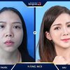 Nâng mũi thẩm mỹ